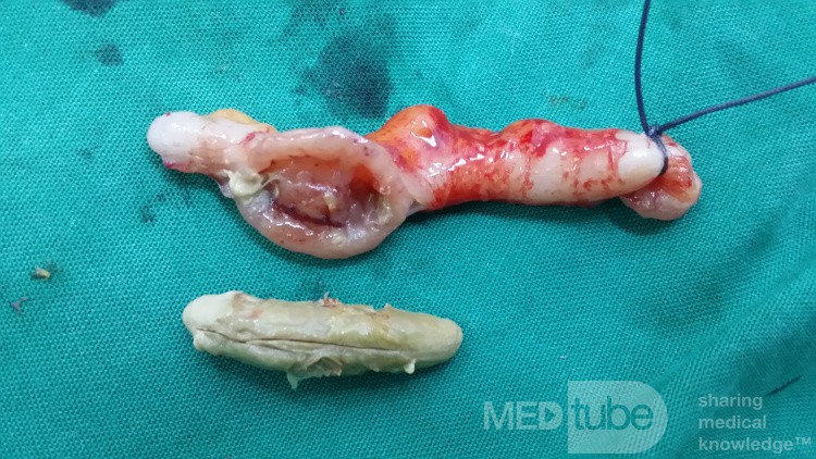 Obstructive Acute Appendicitis