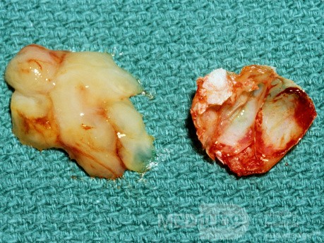 Mucous From Interior of Concha Bullosa [surgical specimen]