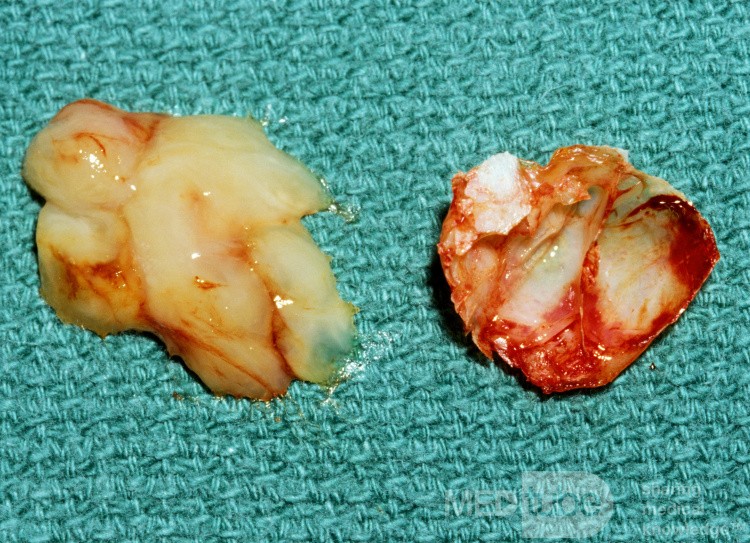 Mucous From Interior of Concha Bullosa [surgical specimen]