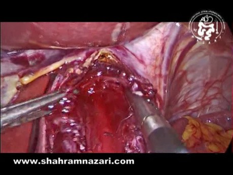 Where is the Target Endpoint of the Myotomy in Heller Myotomy