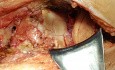 Fracture Tibial Plateau