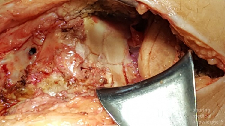 Fracture Tibial Plateau
