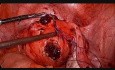 Laparoscopic Myomectomy Step by Step