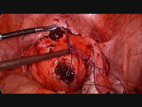Laparoscopic Myomectomy Step by Step