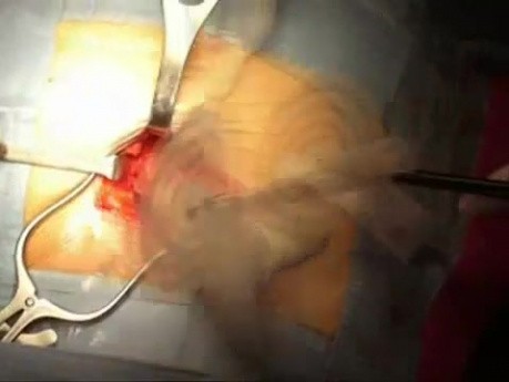 Femoral hernia repair