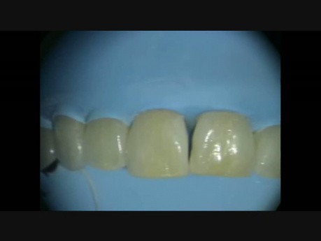 Treatment of the "Black Triangle" with Bioclear Bonding