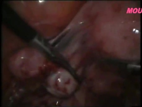 Removal of Peritubal Adhesions Using Laparoscopy
