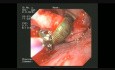 Leech in the Larinx