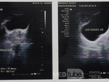 Case of Benign Prostatic Hyperplasia (BPH) in a 71 Years Old Male