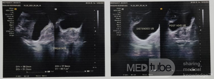 Case of Benign Prostatic Hyperplasia (BPH) in a 71 Years Old Male