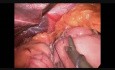 Single Anastomosis Gastric Bypass (Minigastric Bypass) without Special Sealing Devices