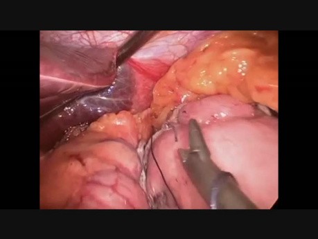Single Anastomosis Gastric Bypass (Minigastric Bypass) without Special Sealing Devices