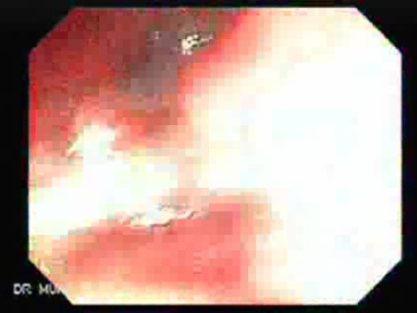 Rectum Adenocarcinoma (3 of 4)