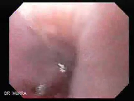 Gastric Heterotopia (inlet pach) (3 of 4)