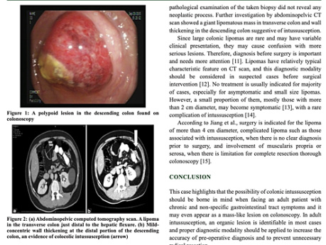 Colocolic Intussusception in a Patient with a Giant Colonic Lipoma