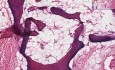 Soft Tissue - Myositis Ossificans