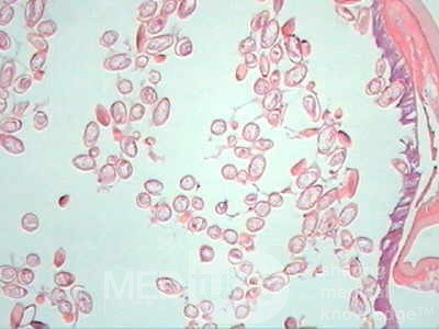 Trichuris Trichuris (whipworm) (12 of 19)