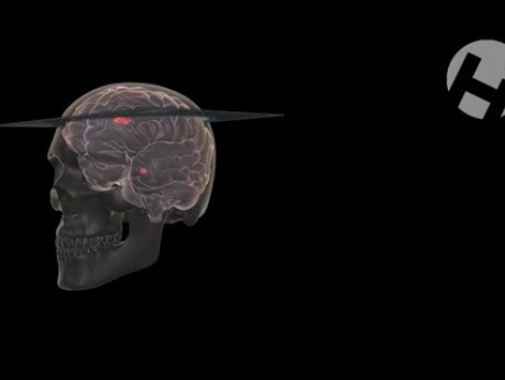 Subdural Hematoma