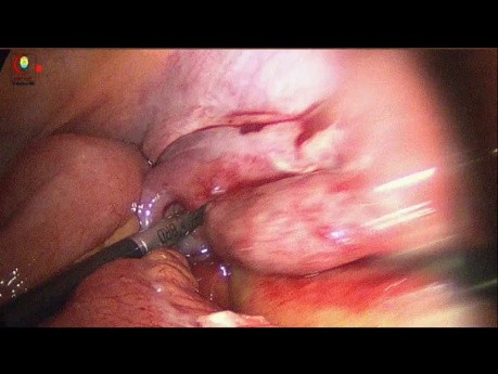Appendicular Mass Dissection