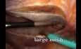 Ventral TAPP for Ombilical Hernia with Concomitant Left Direct Inguinal Hernia (Annotated)