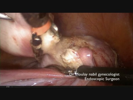 Occlusion of Uterines Arteries by Medial Approach and Myomectomy