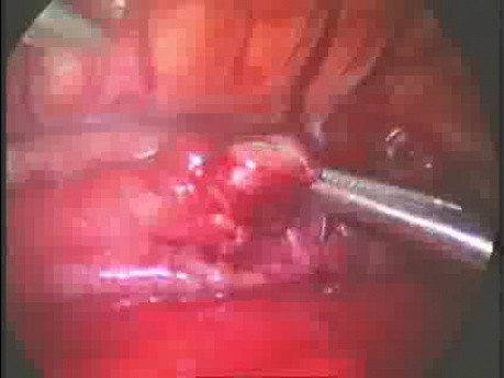 Thoracoscopic repair of esophageal atresia with distal fistula treacheoesophagalis in newborn