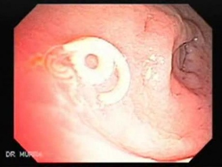 Trichuris Trichuris (whipworm) (3 of 4)