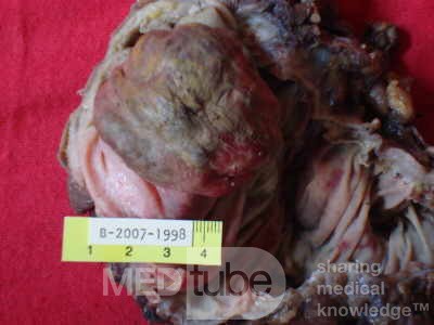 Non - Hodgkin's Lymphoma Of The Cecum (9 of 10)
