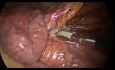 Laparoscopic Subtotal Colectomy