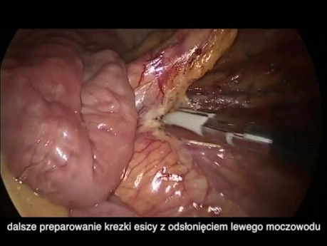 Laparoscopic Subtotal Colectomy