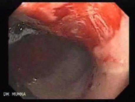 Multiple Gastric Angiodysplasia (15 of 17)