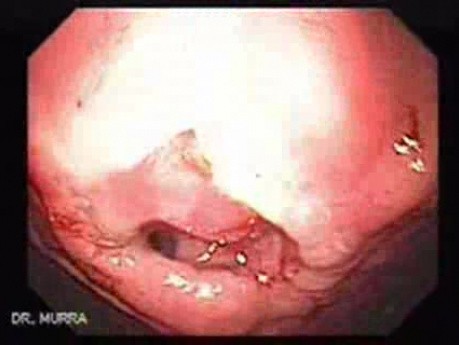 Colonic Interposition for Esophageal Substitution (6 of 11)