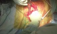 OrthoApproach - Posterior Approach to the Hip Joint | Internervous Planes | Surgical Landmarks