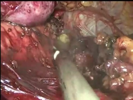 Redo Roux En Y Gastric Bypass - Laparoscopy