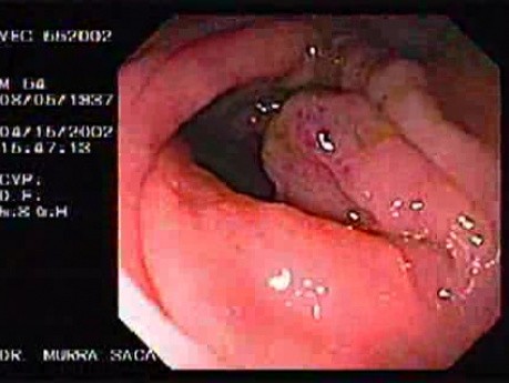 Zollinger- Ellison Syndrome - Gastric Ulcer with Gastrocolic Fistula (2 of 21)