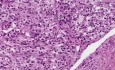 Renal cell carcinoma - Histopathology - Kidney
