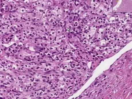 Renal cell carcinoma - Histopathology - Kidney