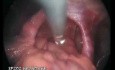 Huge Hiatal Hernia