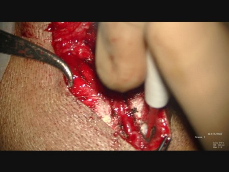 Superficial Temporal Artery Dissection in Preparation for STA-MCA Bypass