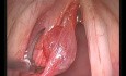 Laryngeal Microsurgery Removal of Left Vocal Cord Cist