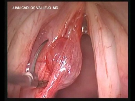 Laryngeal Microsurgery Removal of Left Vocal Cord Cist