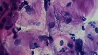 Women - Urethra - Urethritis