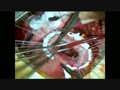 Heartmate II LVAD Inflow Cannulation Technique