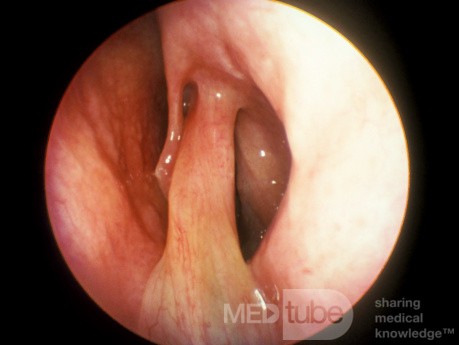 Solitary Large Stalked Nasal Polyp