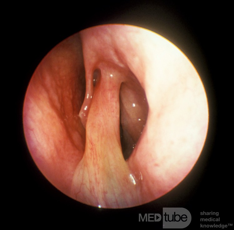 Solitary Large Stalked Nasal Polyp