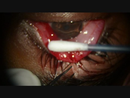 Mullerectomy for Lid Retraction