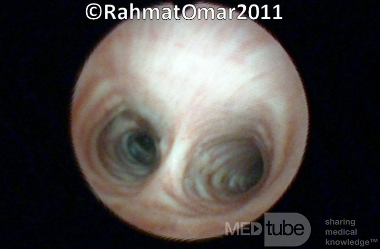 Tracheal Bifurcation
