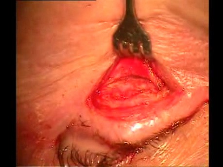 Bloodless entropion surgery