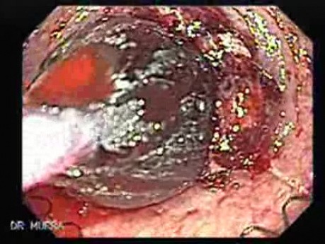 Ablation Of The Distal Esophageal Carcinoma - Part 1