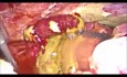 Biliary Peritonitis by Ruptured Cholecystitis, Complete Laparoscopic Cholecystectomy